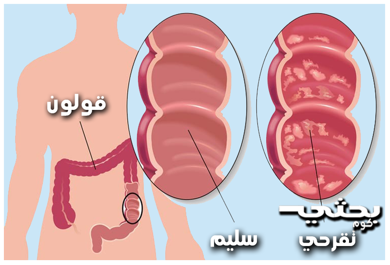 التهاب القولون التقرحي