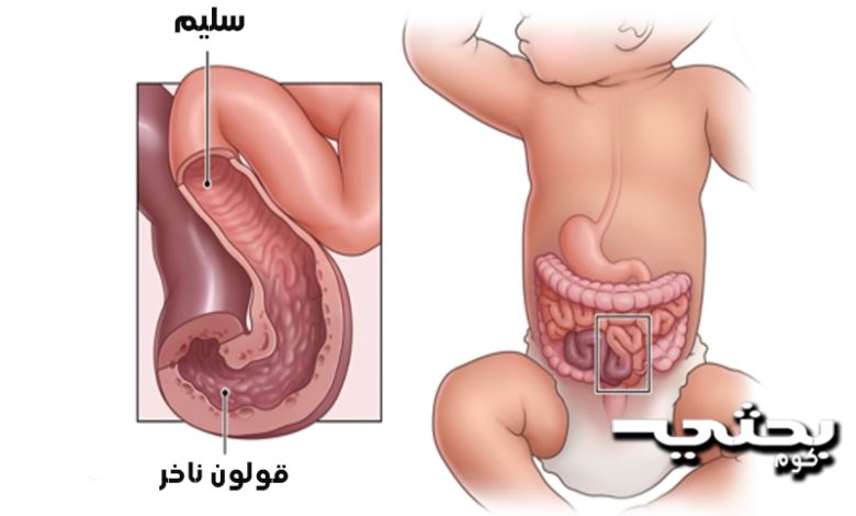 التهاب الأمعاء والقولون الناخر (NEC)
