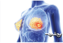 سرطان الثدي،الاسباب،اعراض،العلاج