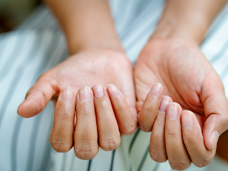 7 Common Nail Conditions Linked to Serious Diseases That You Shouldn’t Ignore