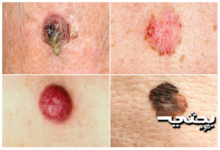 سرطان الجلد الاسباب والاعراض وطرق التعامل