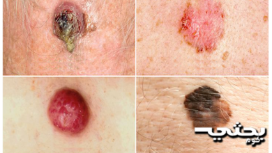 سرطان الجلد الاسباب والاعراض وطرق التعامل