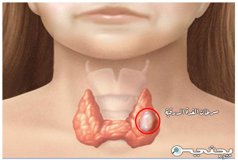 سرطان الغدة الدرقية