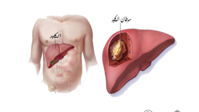 سرطان الكبد