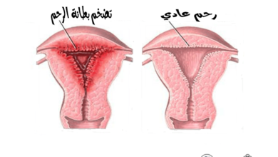 تضخم بطانة الرحم